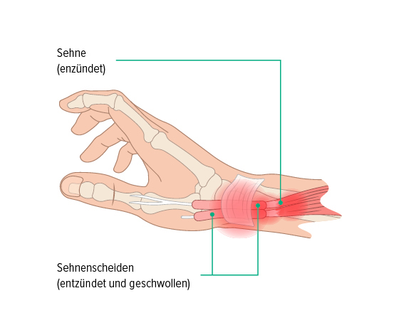 Anatomie einer Sehnenscheidenentzündung Auf dieser Grafik erkennt man die Anatomie einer Hand, die Sehnen verlaufen durch Sehnenscheiden in der Hand