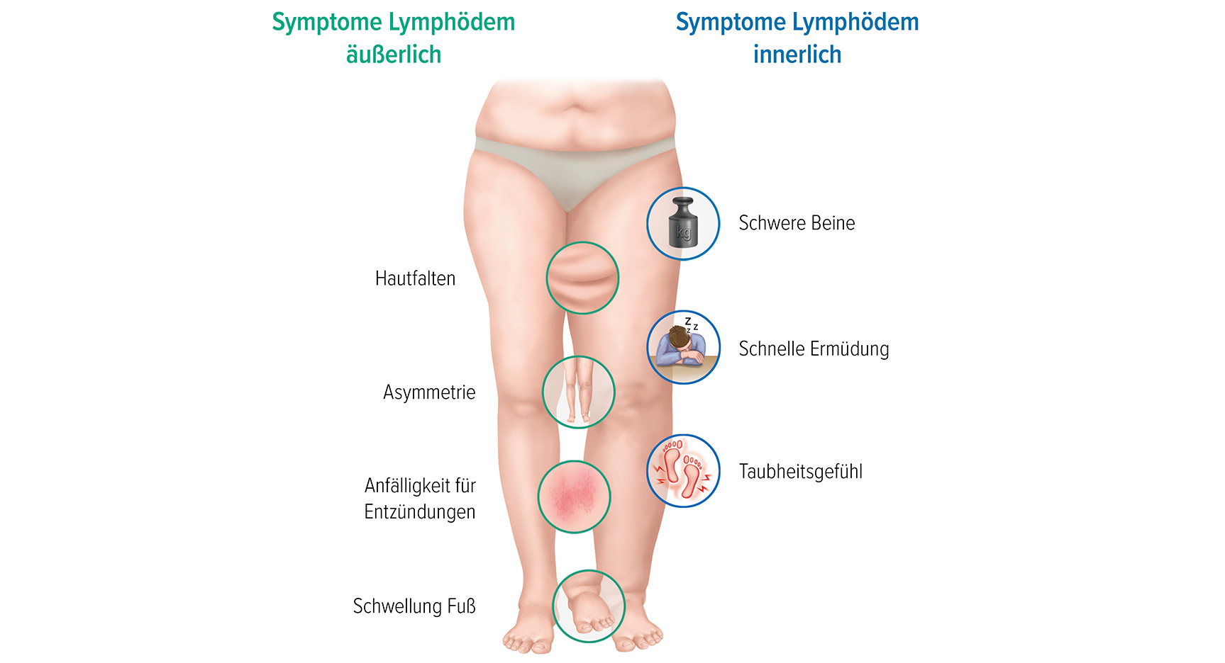 Die Symptome für ein Lymphödem