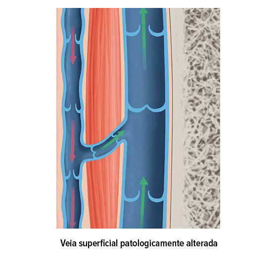 Veia superficial patologicamente alterada Veia superficial patologicamente alterada