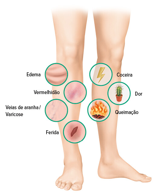 Úlcera venosa – Sintomas Úlcera venosa – Sintomas