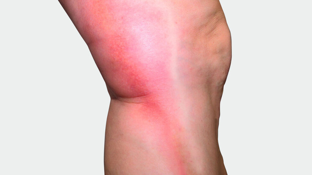 Beininnenseite, an der man eine rote Verfärbung sieht Beininnenseite, an der man eine rote Verfärbung sieht