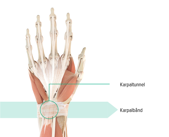 Anatomisk illustration af venstre hånd med markering af karpaltunnelen og karpalleddet